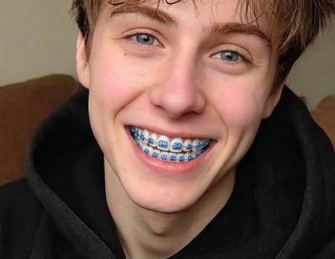Ceramic braces on a boy for filter example photo