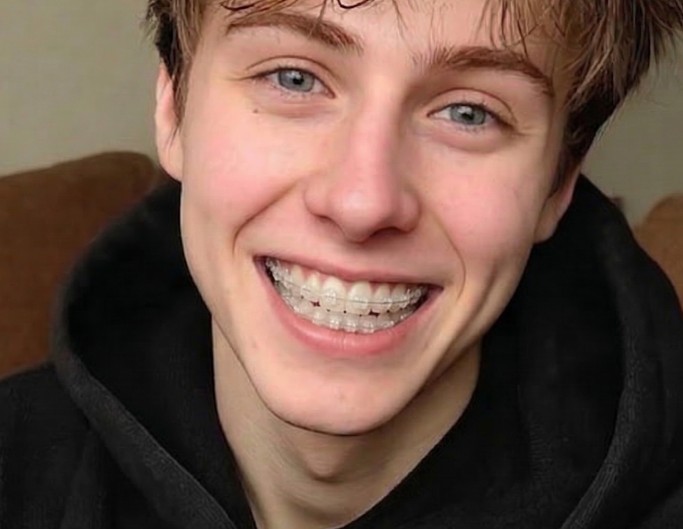 Invisible braces on a boy for filter eample photo