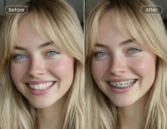 Successful braces filter added photo before vs after