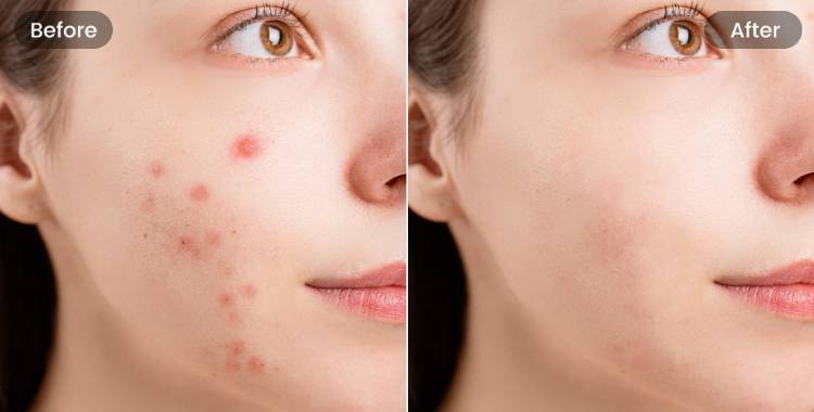 Fotorの消しゴムマジックツールで顔の欠点を消す前後の対比の女性写真