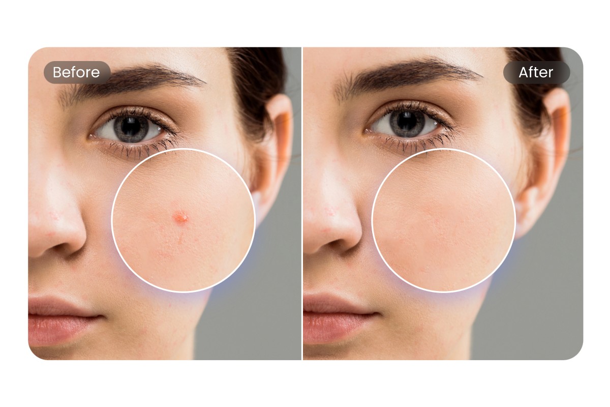 Get rid of skin imperfections with Fotor