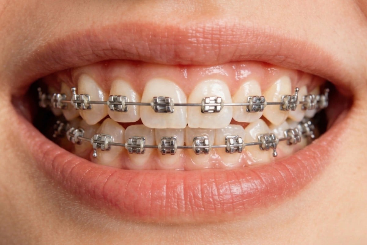 Teeth after seeing a dentist to add braces