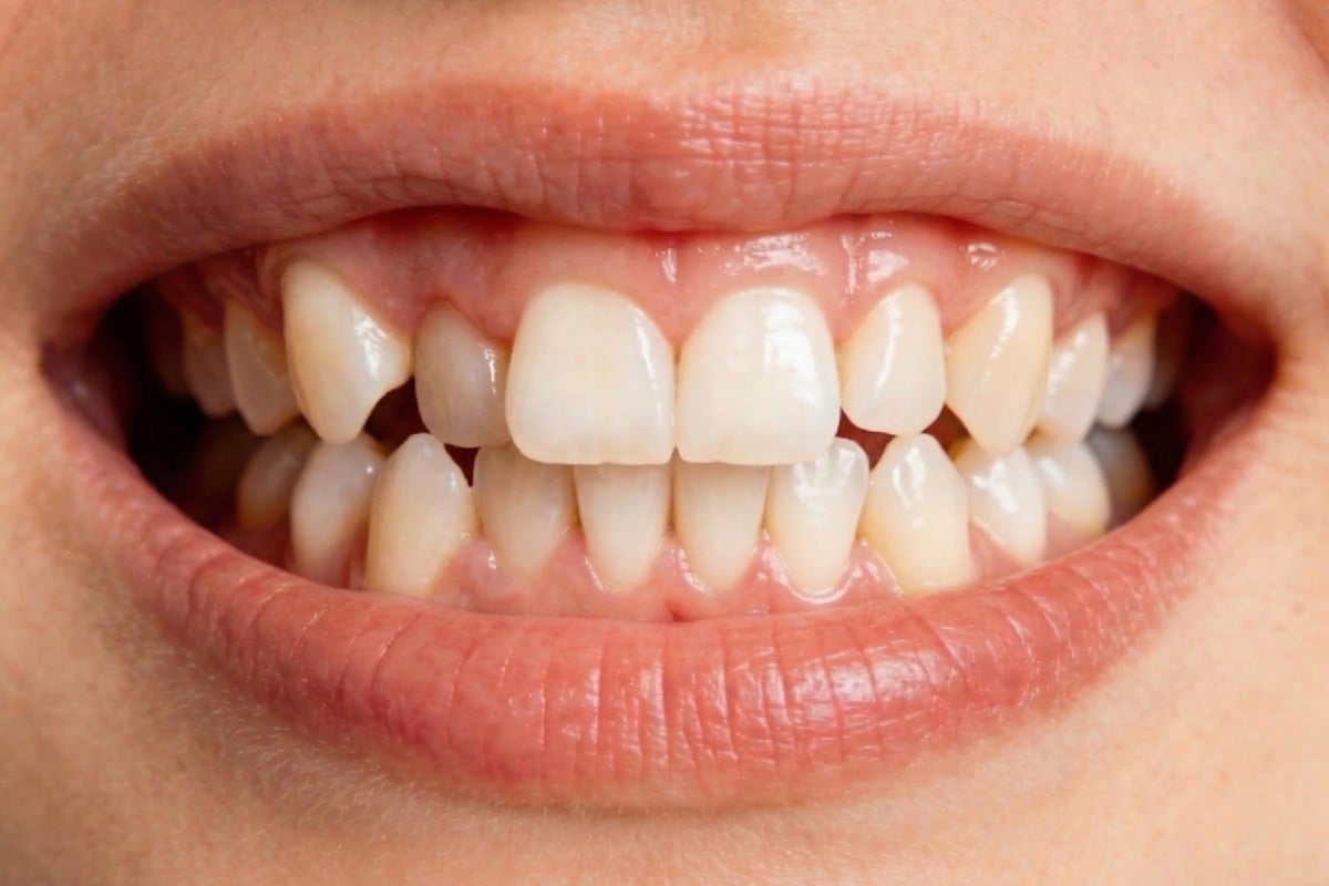 Teeth before seeing a dentist to add braces