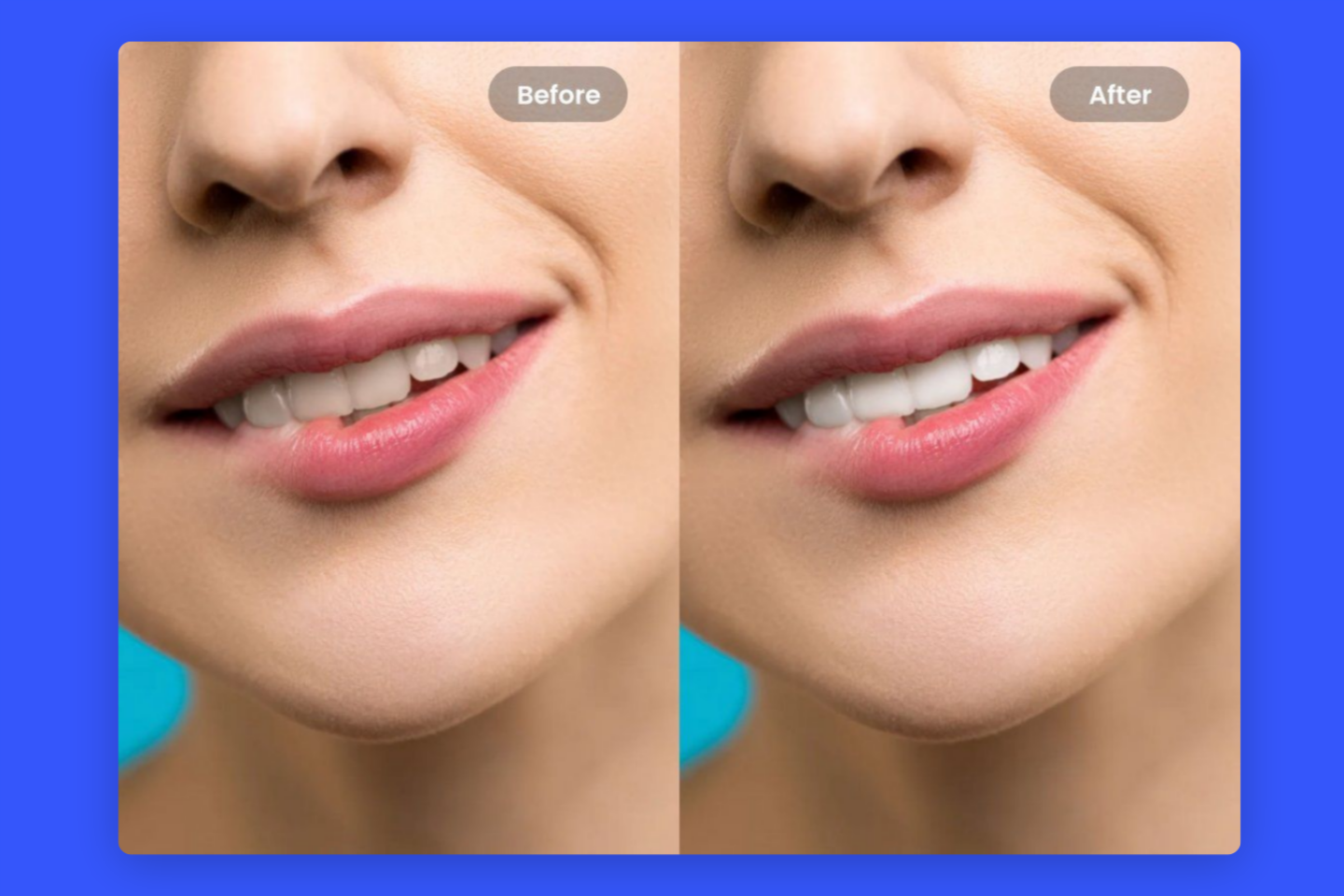 Una cara sonriente con sus dientes blanqueados en fotos antes y después